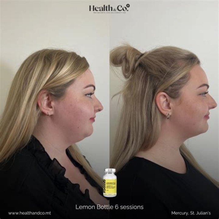 Can I use lemon directly on my face?