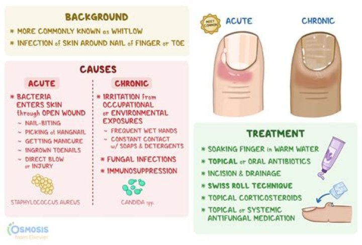 Can ingrown toenail cause sepsis?