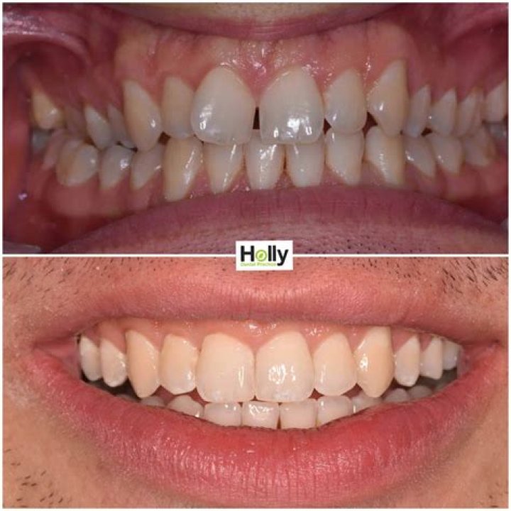 Can Invisalign fix really crooked teeth?