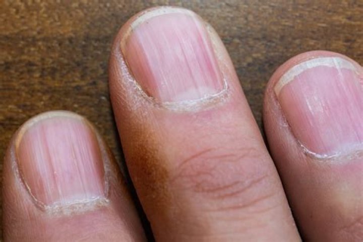 Can iron deficiency affect nails?