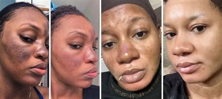 Can kojic acid permanently whiten skin?