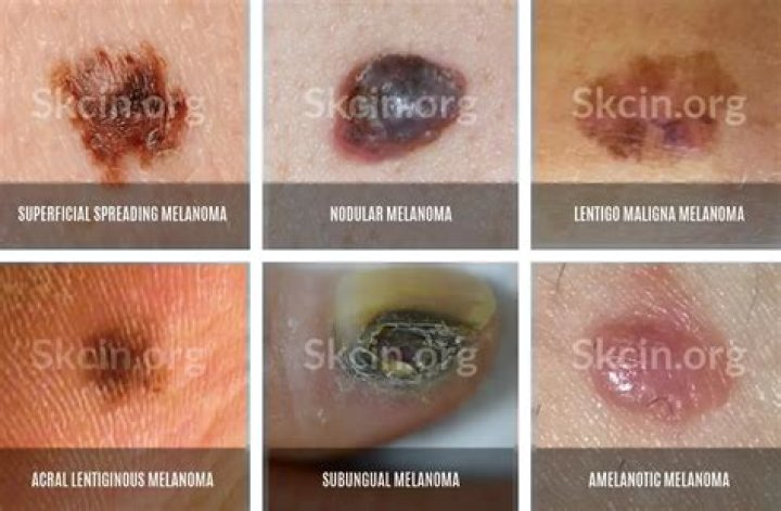 Can melanoma heal itself?