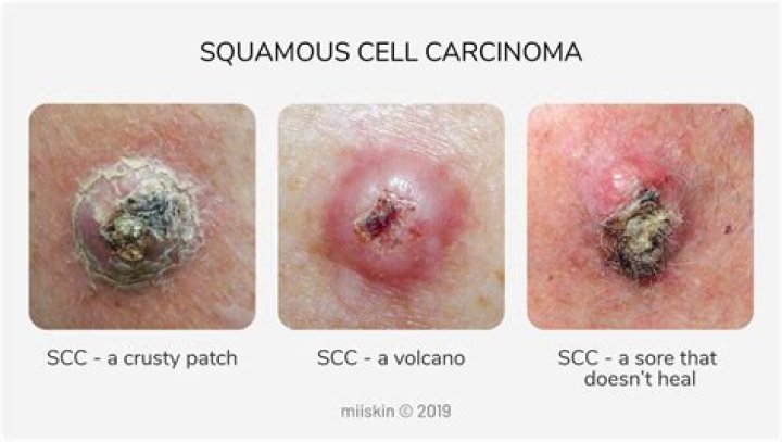 Can melanoma look like a scab?