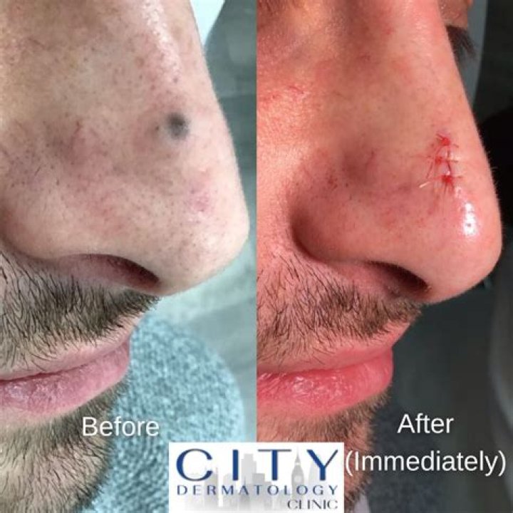 Can melanoma spread after mole removal?