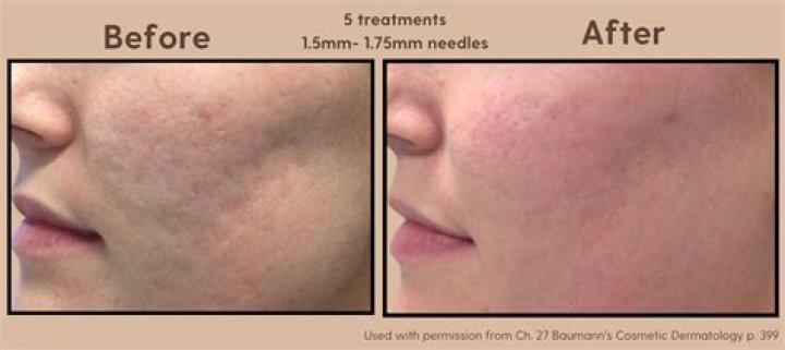 Can microneedling shrink pores?