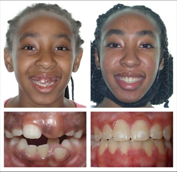 Can my 8 year old get braces?