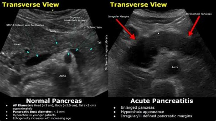 Can pancreatitis be seen on ultrasound?