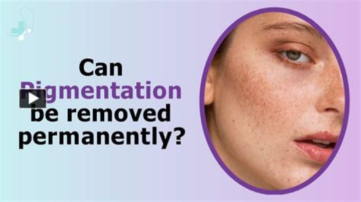 Can pigmentation be removed?