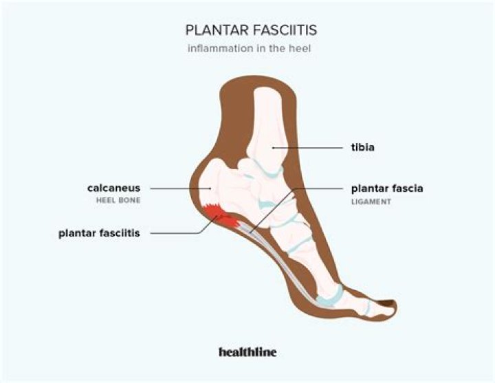 Can plantar fasciitis cause ankle pain?
