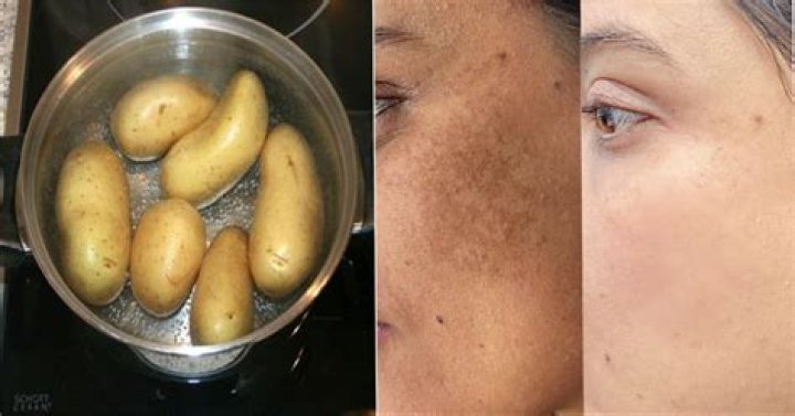 Can potatoes lighten skin?