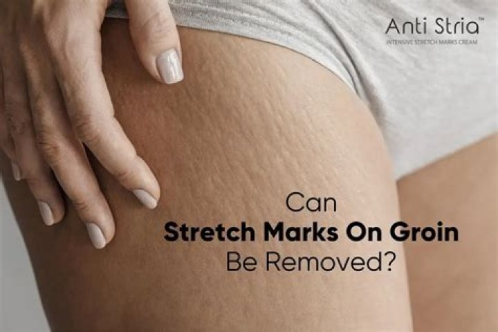 Can Salt remove stretch marks?