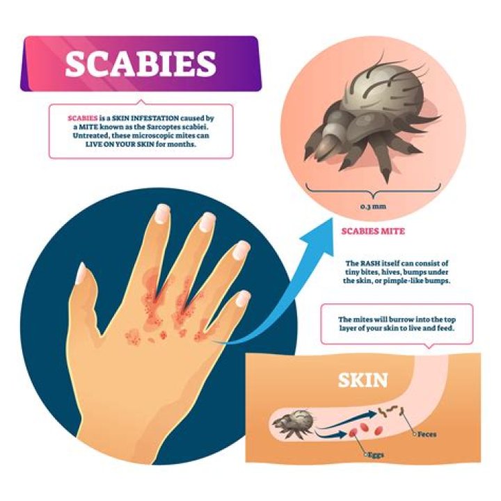 Can scabies live inside your mouth?