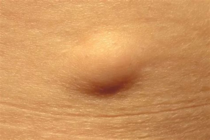 Can scar tissue form lump under skin?