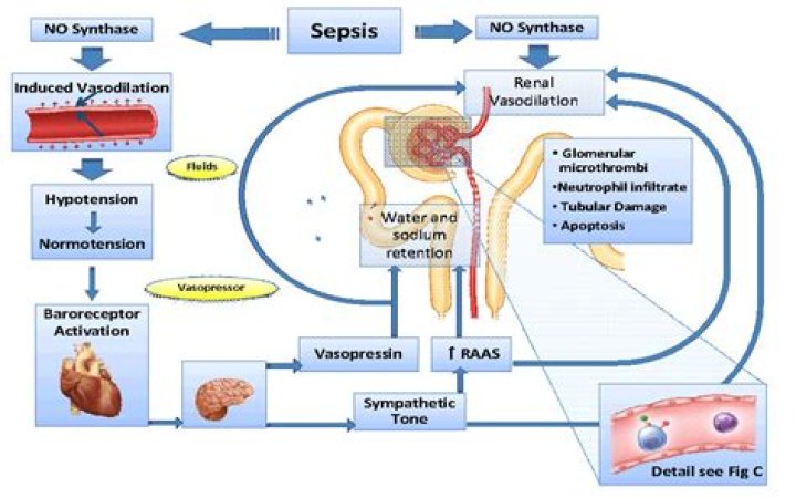 Can sepsis cause kidney failure?