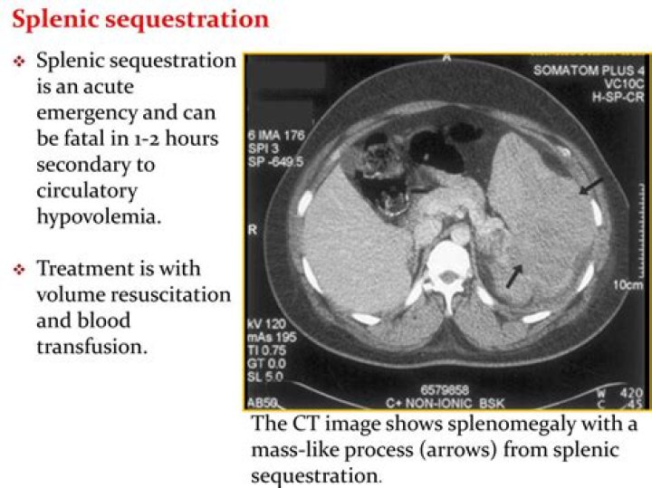 Can splenic sequestration cause death?