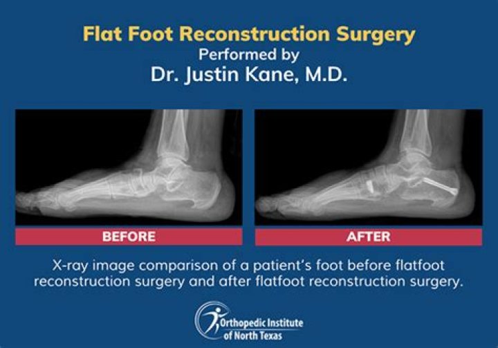 Can surgery correct flat feet?