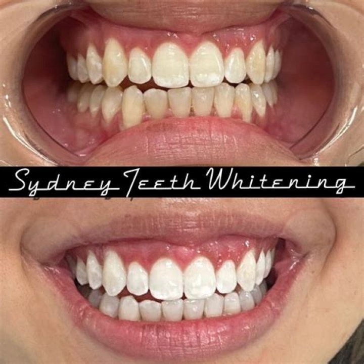 Can teenager whiten teeth?