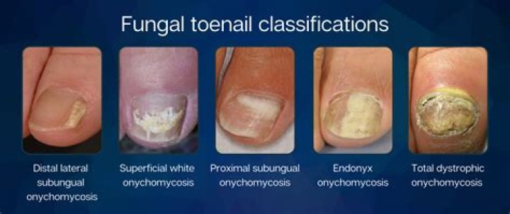 Can toenail fungus last for years?