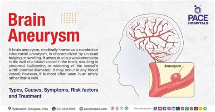 Can vaping cause brain aneurysm?