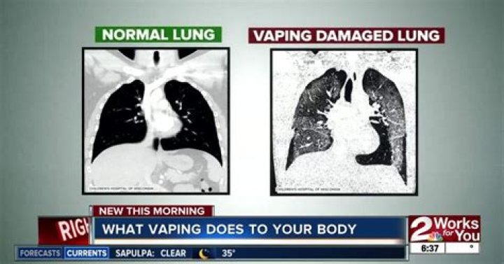 Can vaping cause pneumonia?
