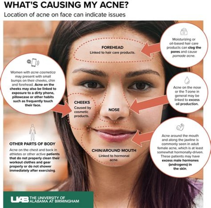 Can Vaseline give you acne?