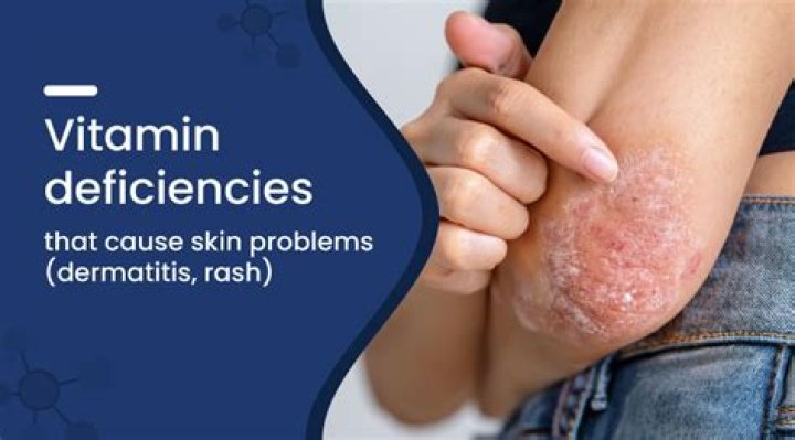 Can vitamin D deficiency cause warts?