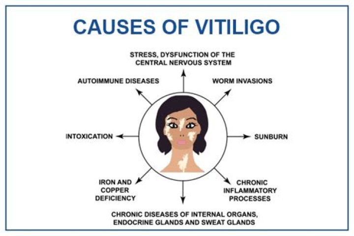 Can vitiligo be caused by stress?