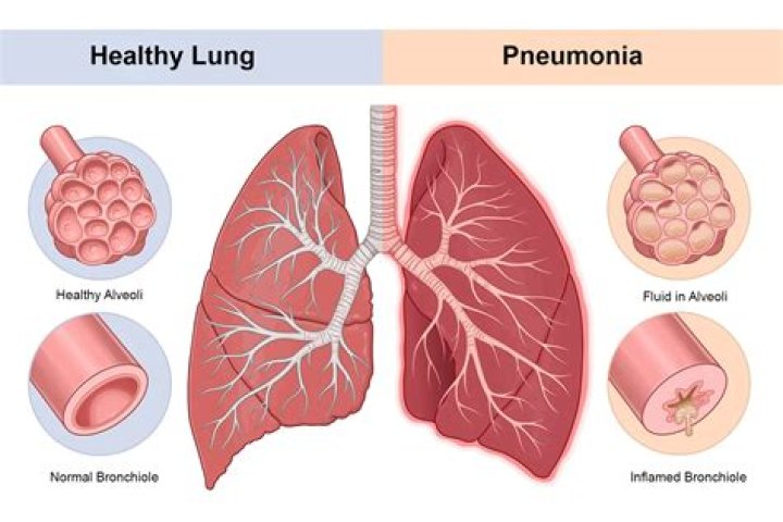 Can welding cause pneumonia?