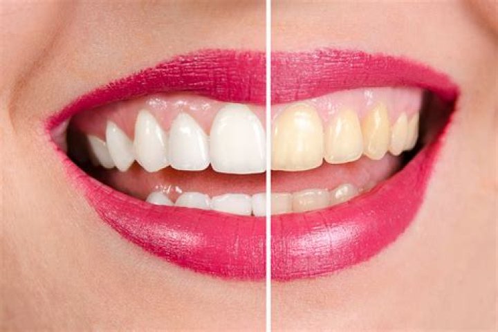 Can yellow teeth be whitened?