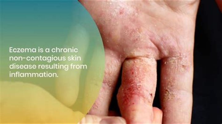 Can yogurt help eczema?