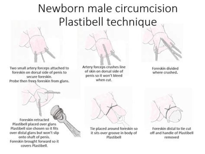 Can you circumcise yourself?