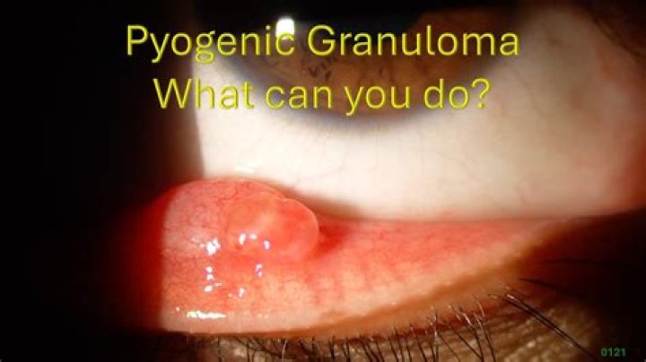 Can you feel a granuloma?
