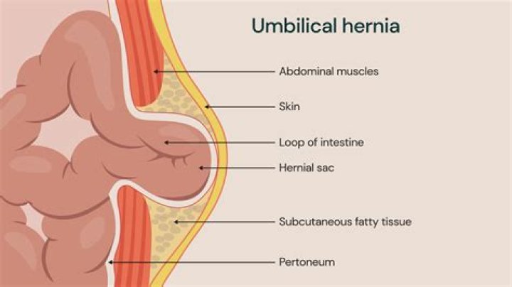 Can you feel unwell with a hernia?