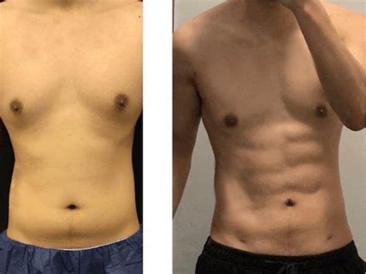 Can you get a six pack after tummy tuck?