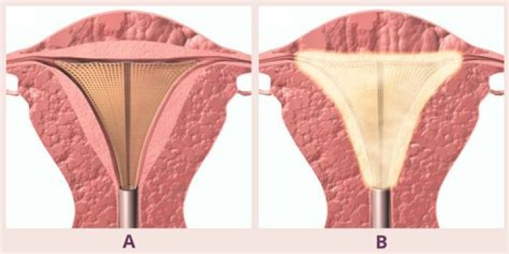 Can you get an ablation twice?