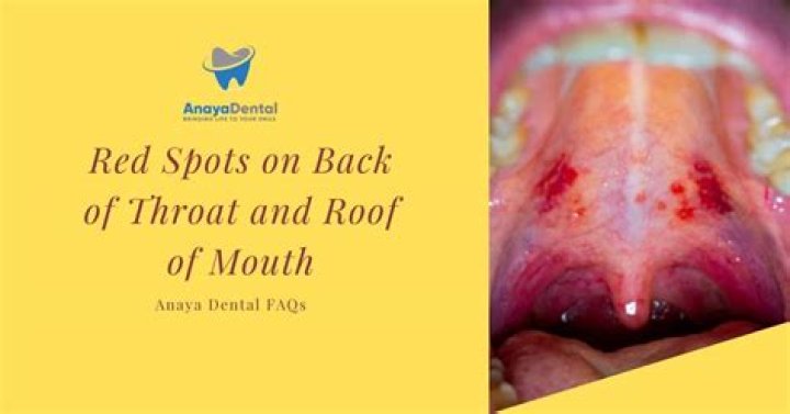 Can you get spots in your mouth?