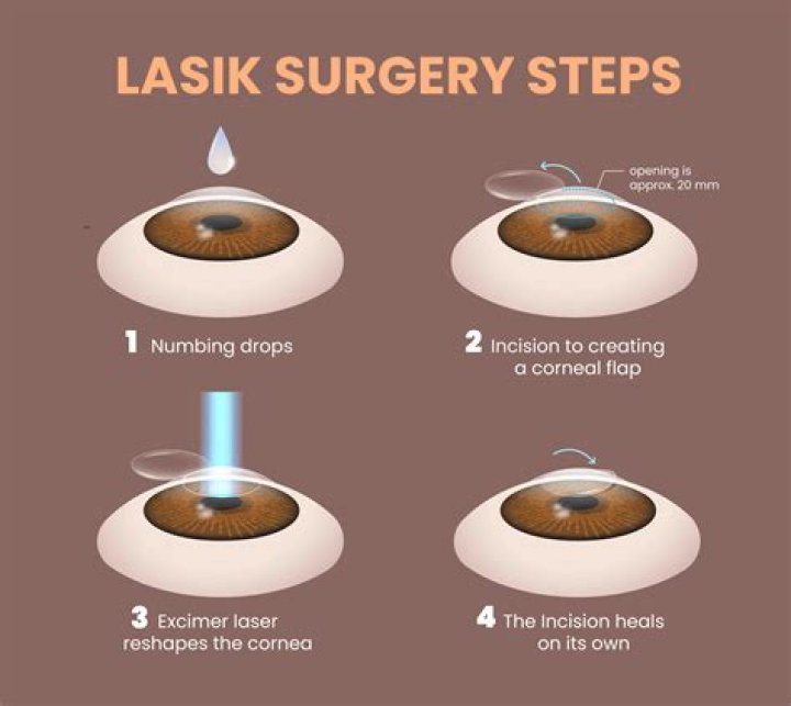 Can you get sweat in your eyes after LASIK?
