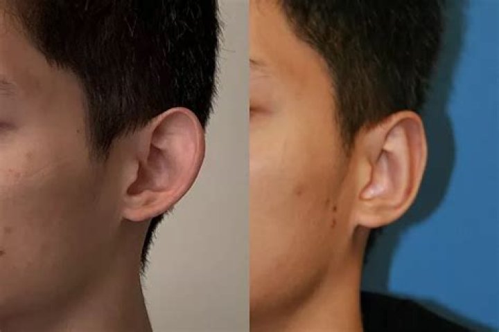 Can you have otoplasty twice?