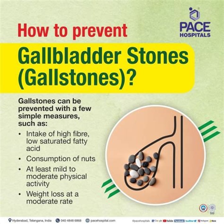 Can you live with gallstones forever?