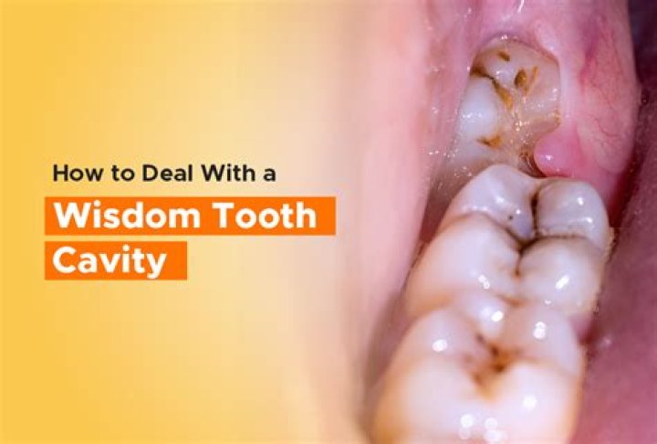Can you live with wisdom teeth?
