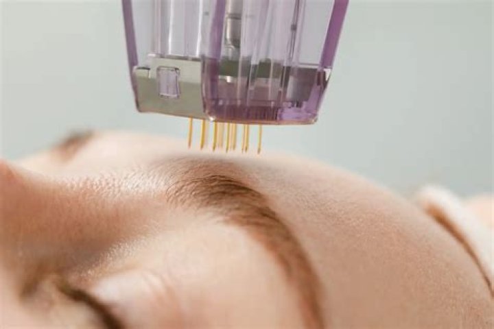 Can you microneedle a keloid scar?