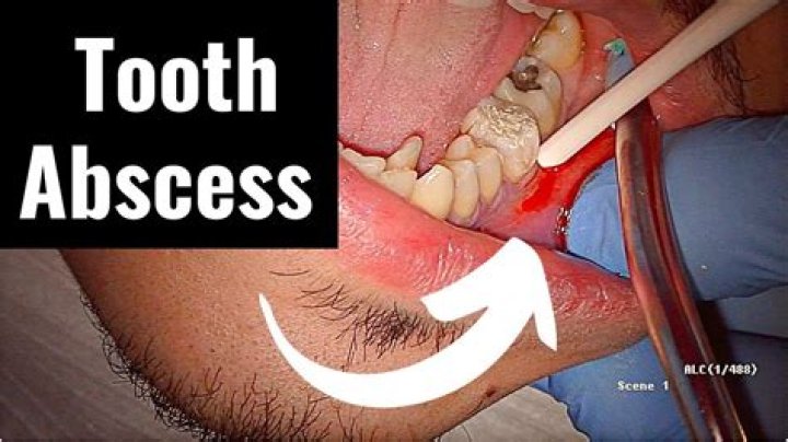 Can you pop a tooth abscess at home?