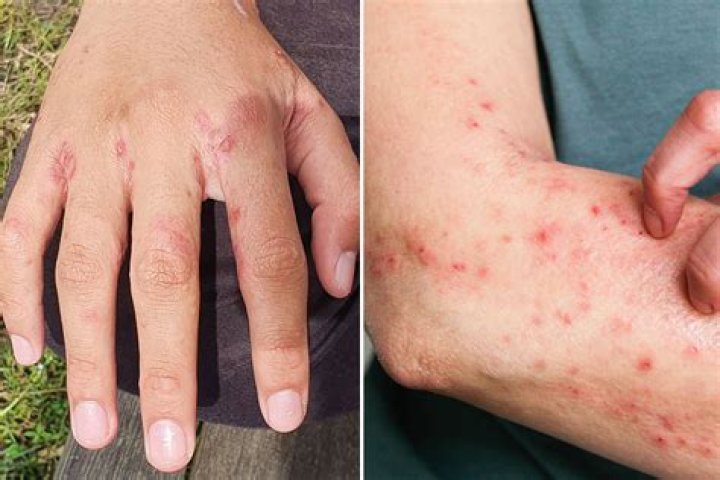 Can you pull scabies out of your skin?