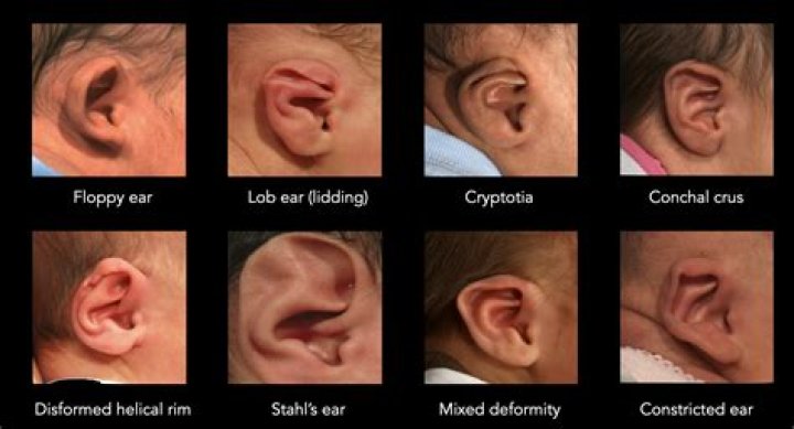 Can you reshape ear cartilage?