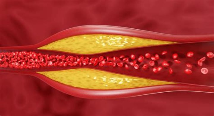 Can you reverse cholesterol buildup in arteries?
