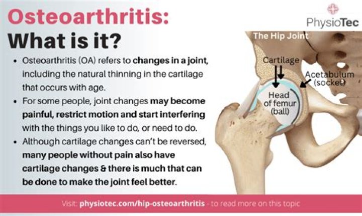 Can you run with osteoarthritis in hips?