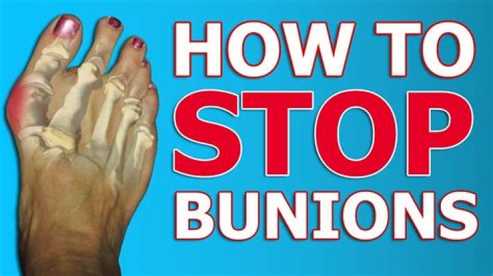 Can you stop bunions from forming?