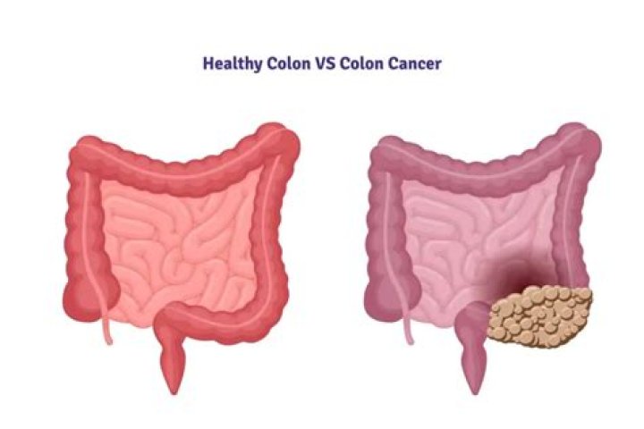 Can your colon heal itself?