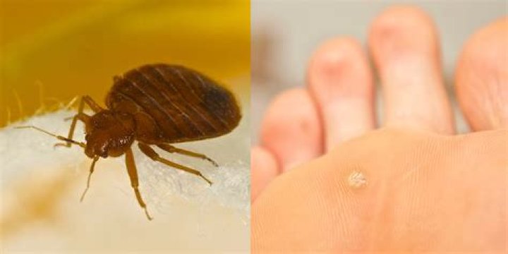 Do bed bugs burrow under the skin?