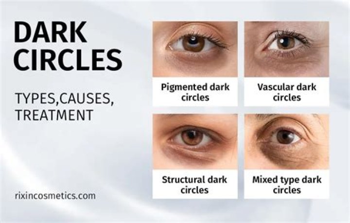 Do dark circles get worse with age?